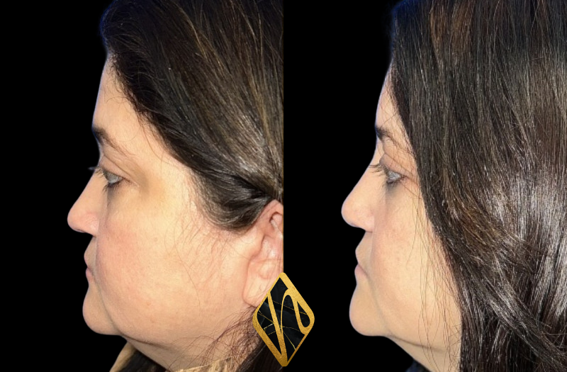 Ethnic Rhinoplasty Combined Image