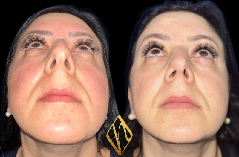 Ethnic Rhinoplasty Combined Image