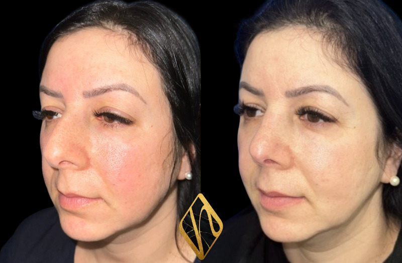 Ethnic Rhinoplasty Combined Image