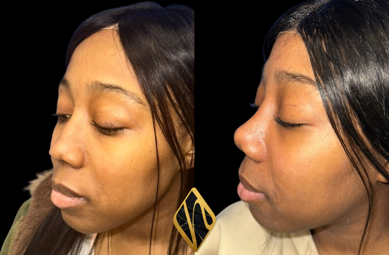 Ethnic Rhinoplasty Combined Image