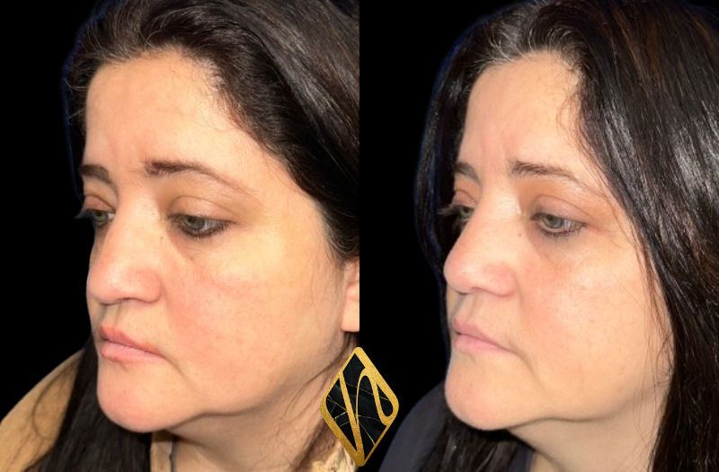 Ethnic Rhinoplasty Combined Image