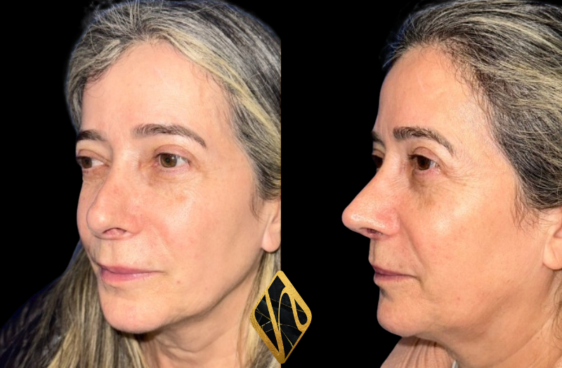 Revision Rhinoplasty Combined Image