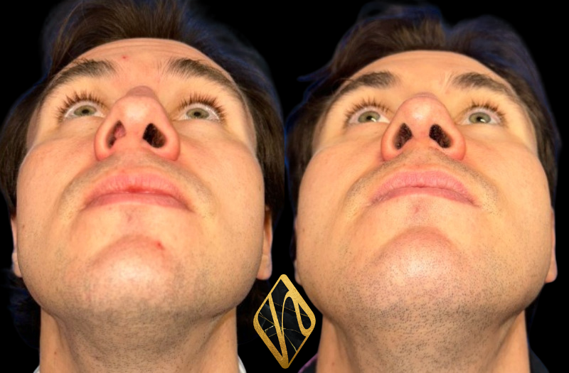Rhinoplasty Combined Image