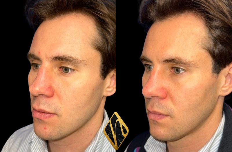 Rhinoplasty Combined Image