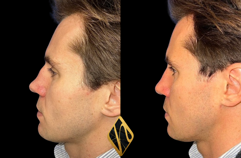 Rhinoplasty Combined Image
