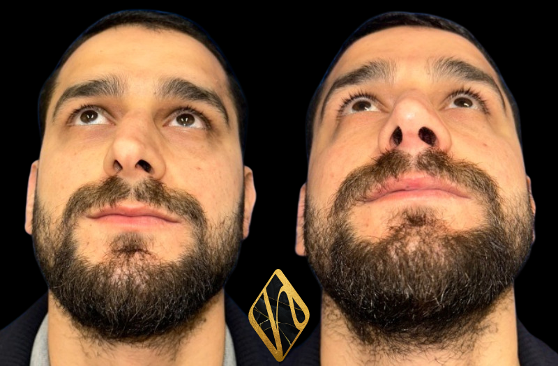 Rhinoplasty Combined Image