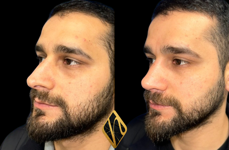 Rhinoplasty Combined Image