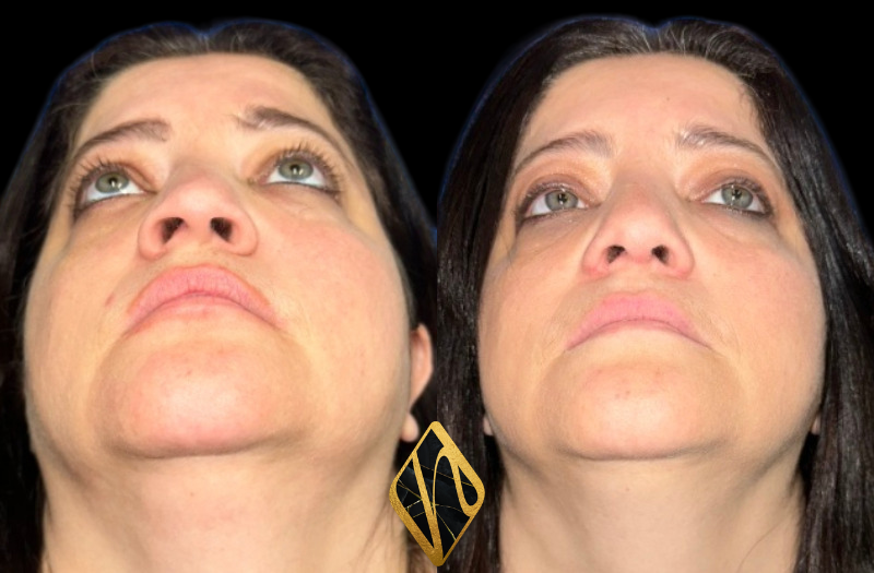 Ethnic Rhinoplasty Combined Image