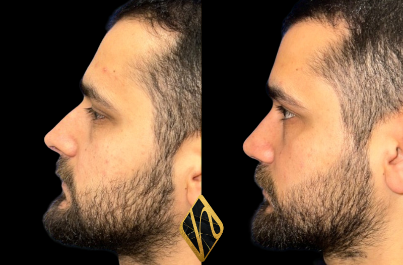 Rhinoplasty Combined Image