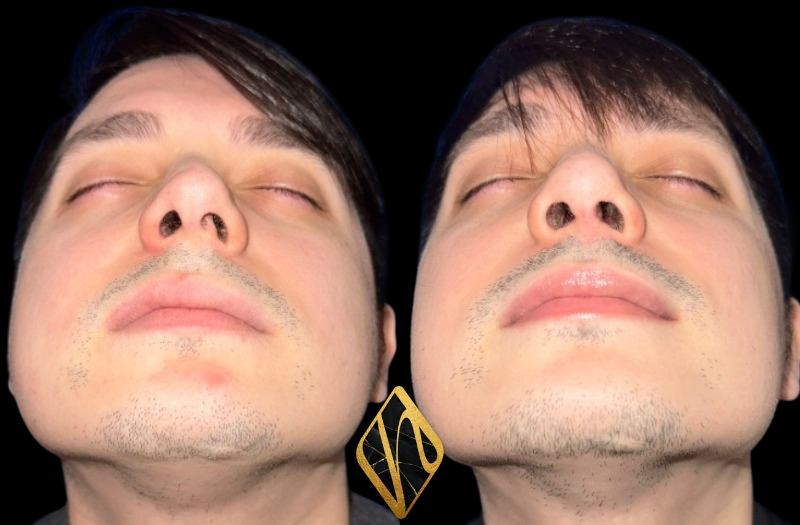 Rhinoplasty Combined Image