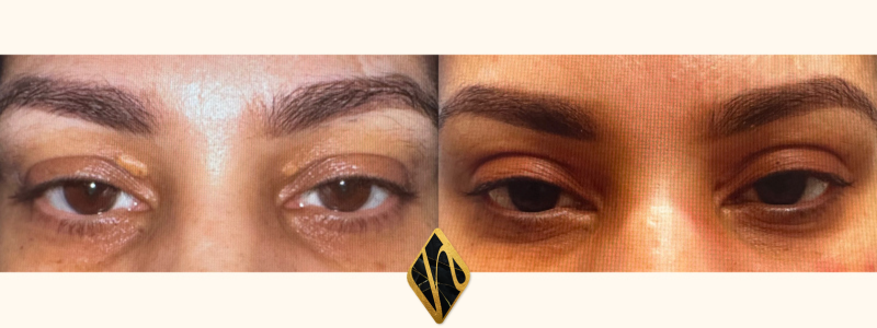 Upper Blepharoplasty Combined Image