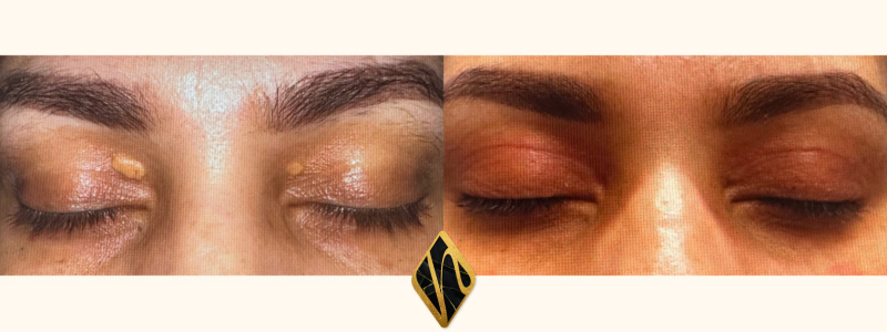 Upper Blepharoplasty Combined Image