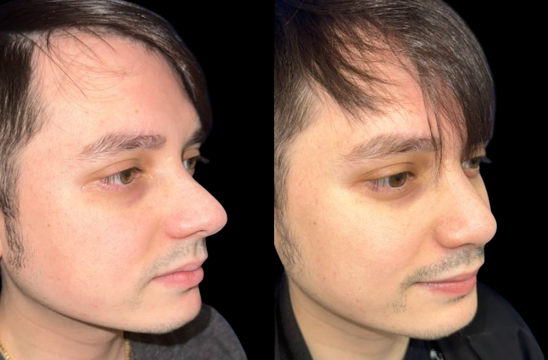 Rhinoplasty 3 Combined Image