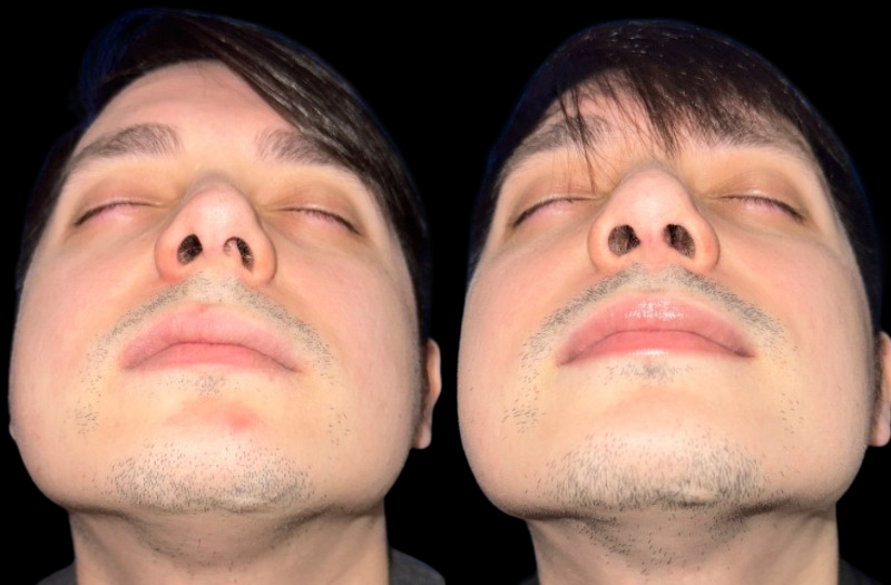 Rhinoplasty 3 Combined Image