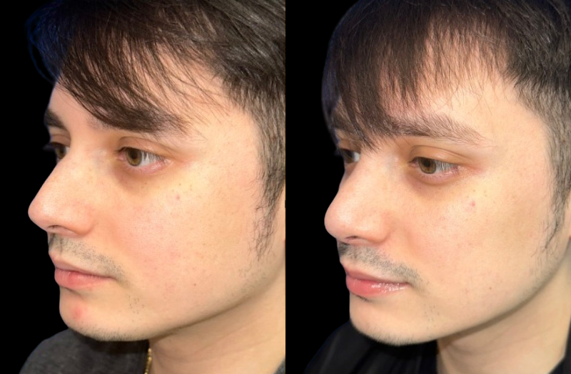 Rhinoplasty 3 Combined Image
