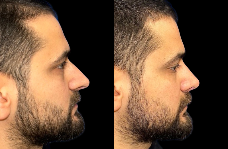 Rhinoplasty 2 Combined Image