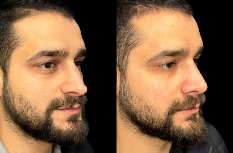 Rhinoplasty 2 Combined Image