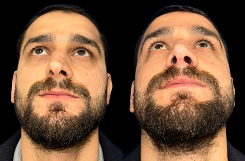 Rhinoplasty 2 Combined Image
