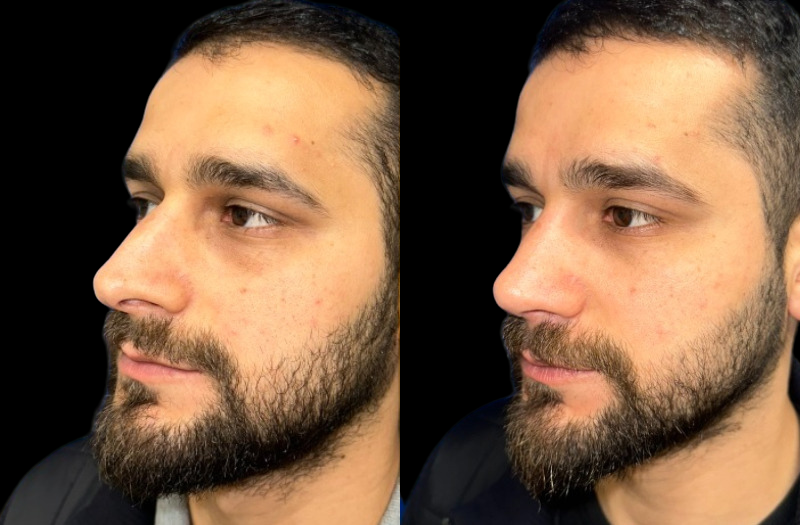 Rhinoplasty 2 Combined Image