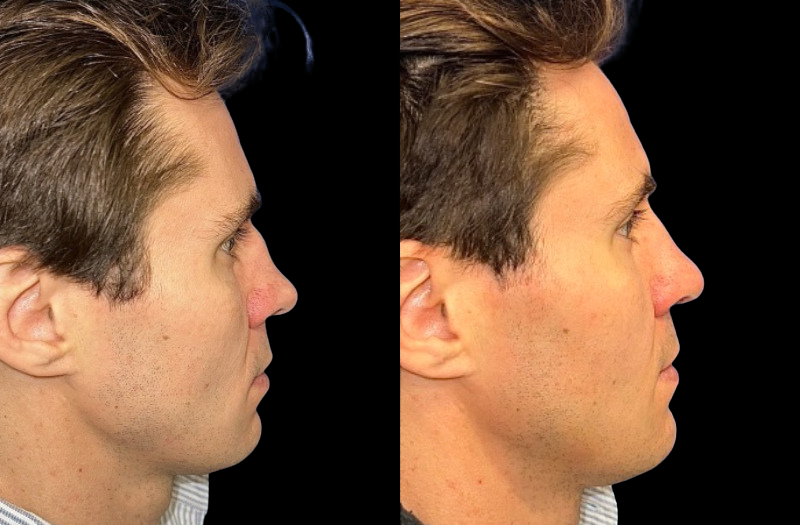 Rhinoplasty 1 Combined Image