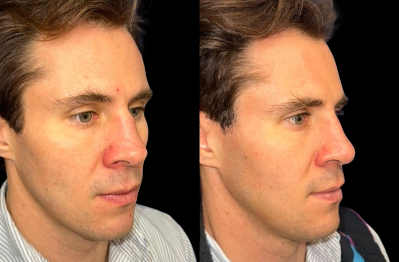 Rhinoplasty 1 Combined Image