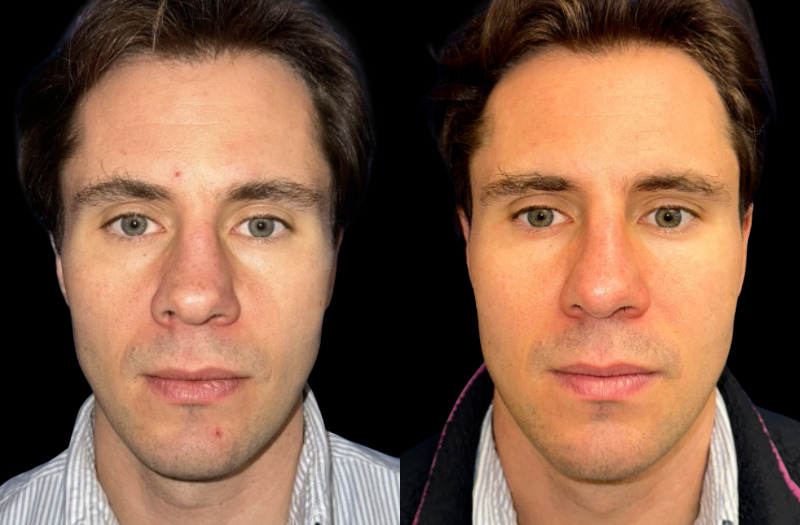 Rhinoplasty 1 Combined Image