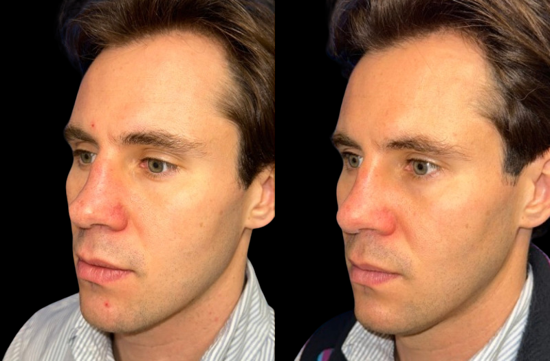 Rhinoplasty 1 Combined Image