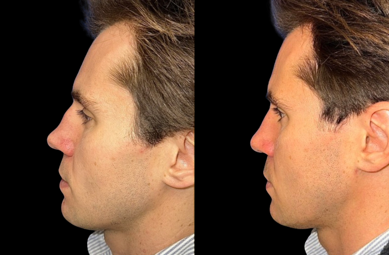 Rhinoplasty 1 Combined Image