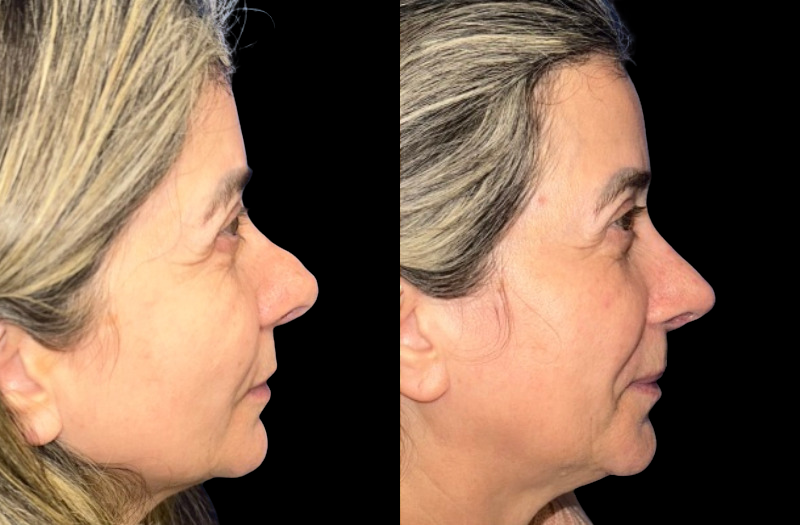 Revision Rhinoplasty 1 Combined Image