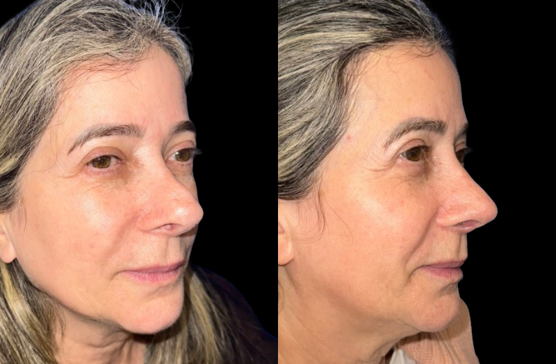 Revision Rhinoplasty 1 Combined Image