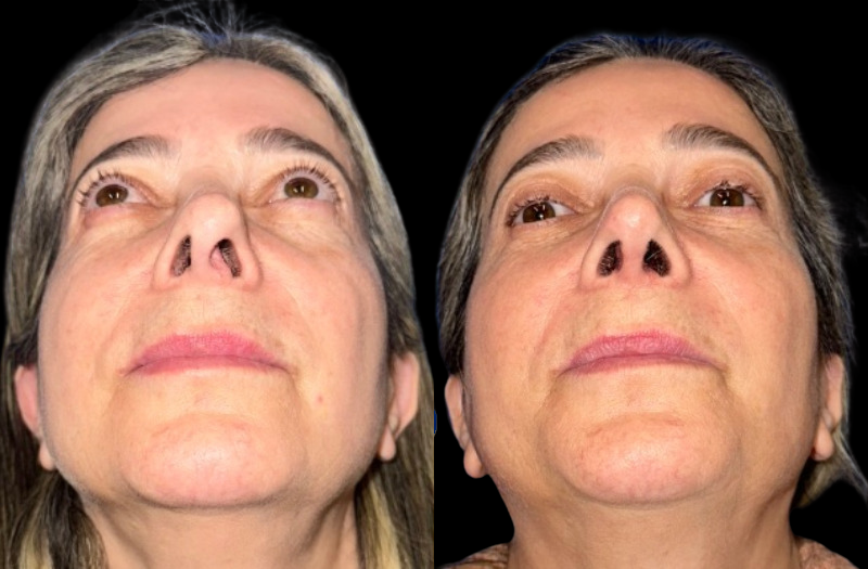 Revision Rhinoplasty 1 Combined Image