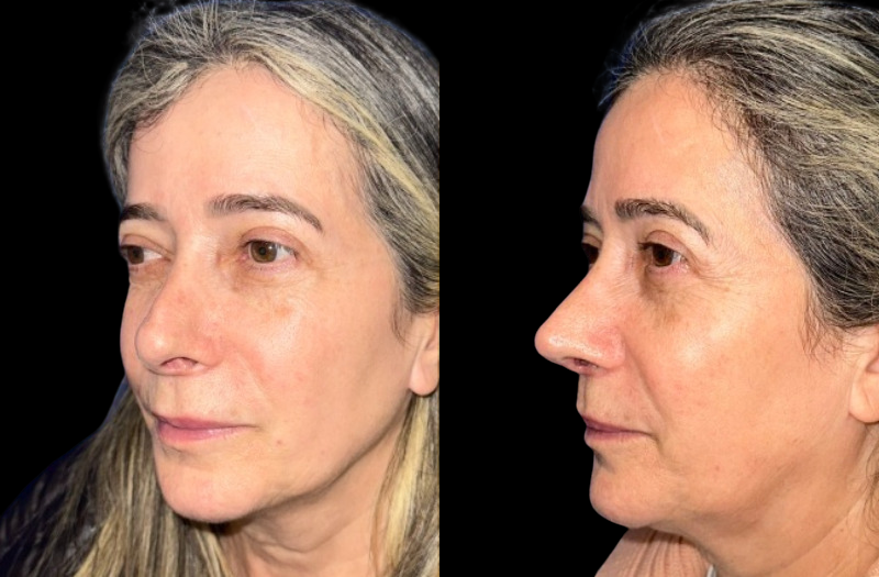 Revision Rhinoplasty 1 Combined Image
