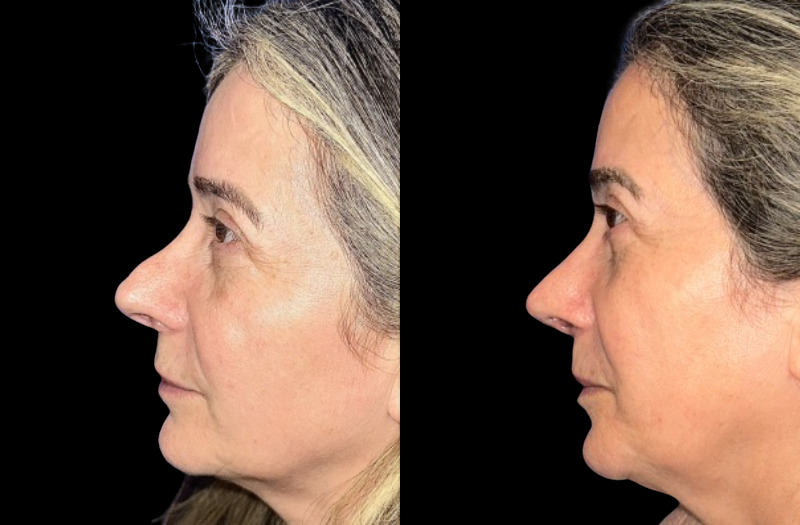 Revision Rhinoplasty 1 Combined Image