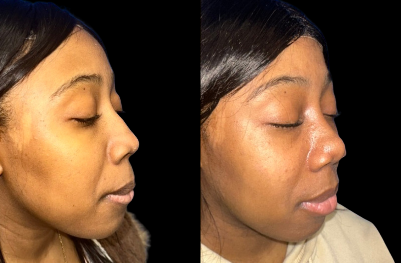 Ethnic Rhinoplasty 3 Combined Image