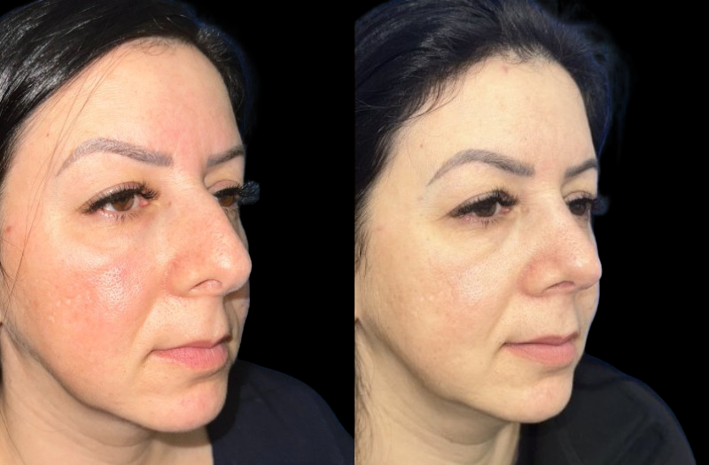 Ethnic Rhinoplasty 2 Combined Image