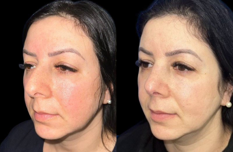 Ethnic Rhinoplasty 2 Combined Image