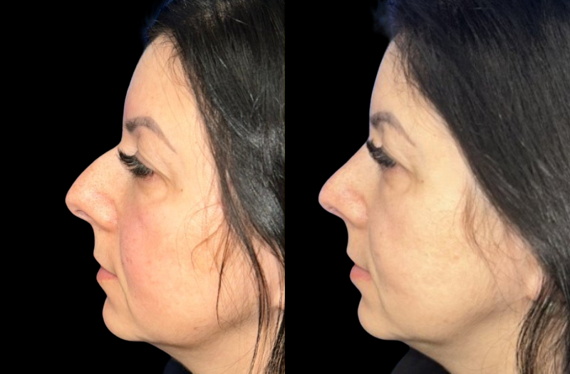 Ethnic Rhinoplasty 2 Combined Image