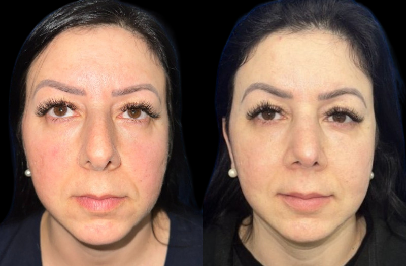 Ethnic Rhinoplasty 2 Combined Image