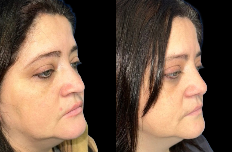 Ethnic Rhinoplasty 1 Combined Image