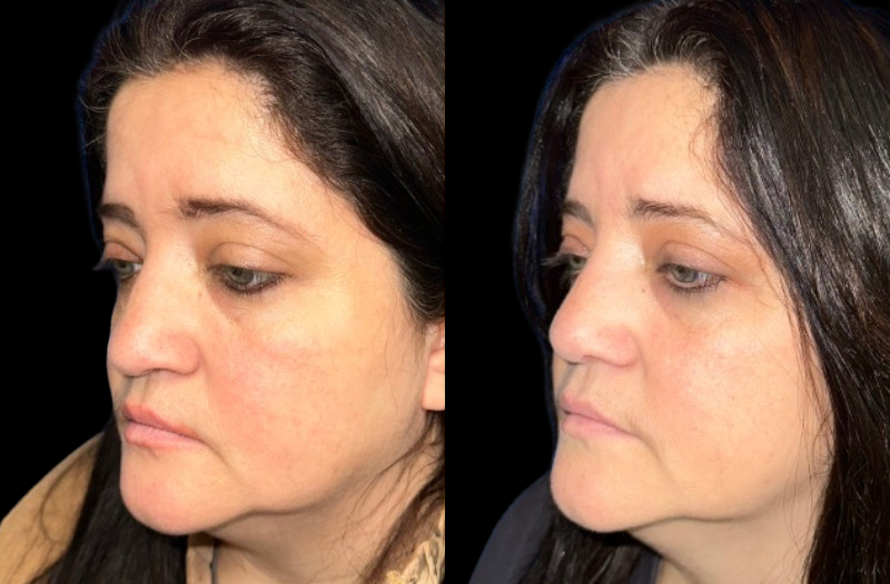 Ethnic Rhinoplasty 1 Combined Image