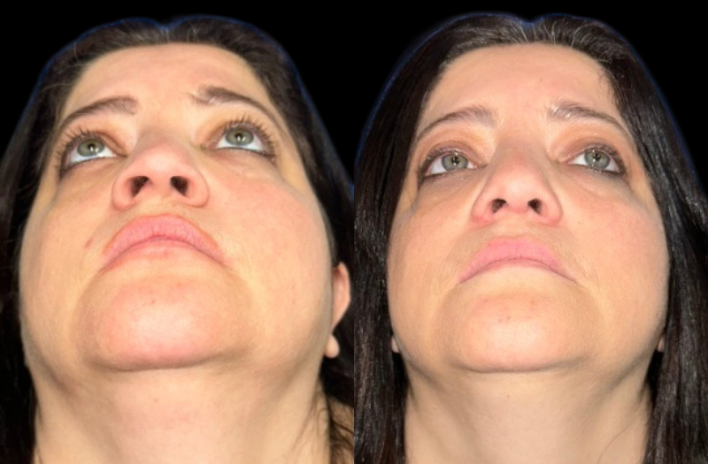 Ethnic Rhinoplasty 1 Combined Image