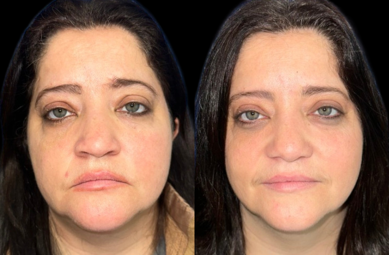 Ethnic Rhinoplasty 1 Combined Image