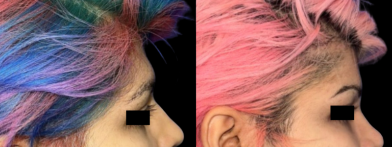 Forehead Contouring 1 Combined Image