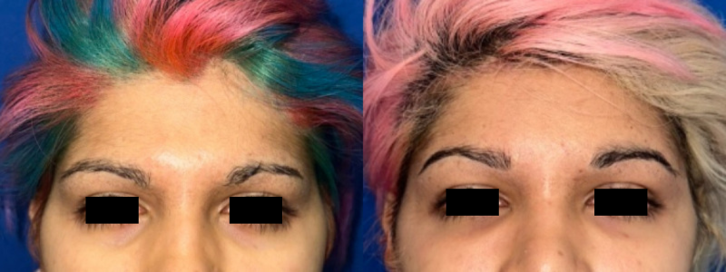 Forehead Contouring 1 Combined Image