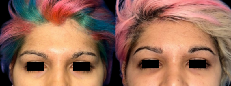Forehead Contouring 1 Combined Image