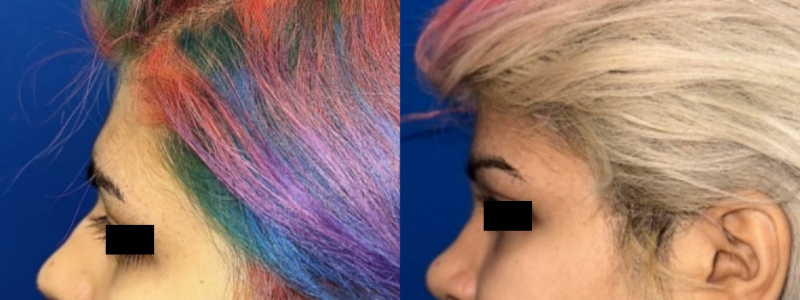 Forehead Contouring 1 Combined Image