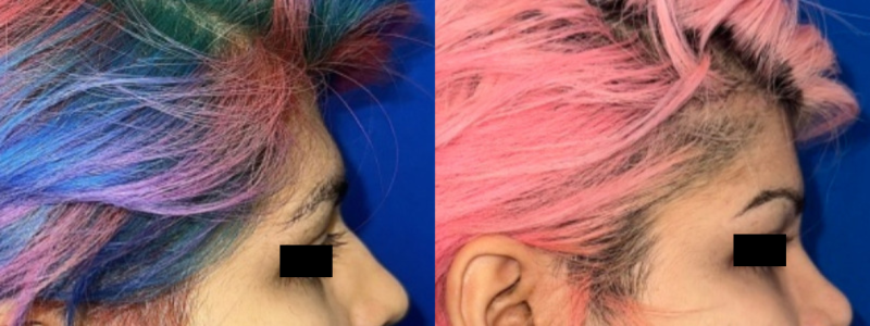 Forehead Contouring 1 Combined Image