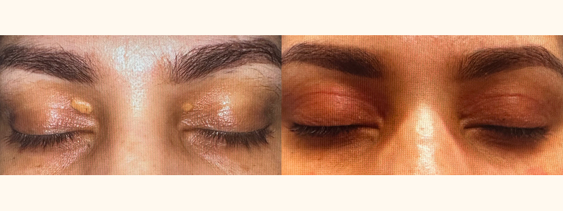 Upper Blepharoplasty 1 Combined Image