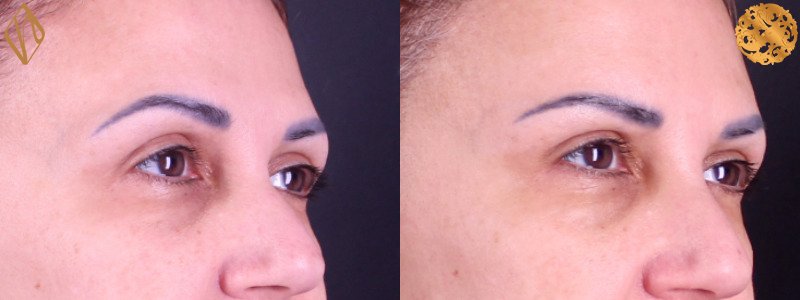 Brow Lift 1 Combined Image