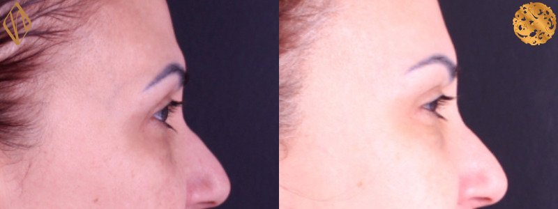 Brow Lift 1 Combined Image